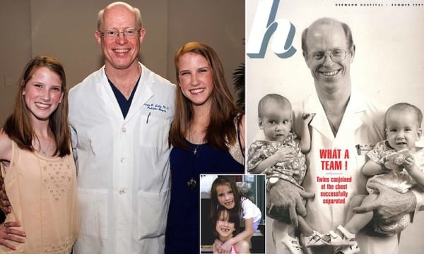 Одна жизнь на двоих: История милых сиамских близнецов