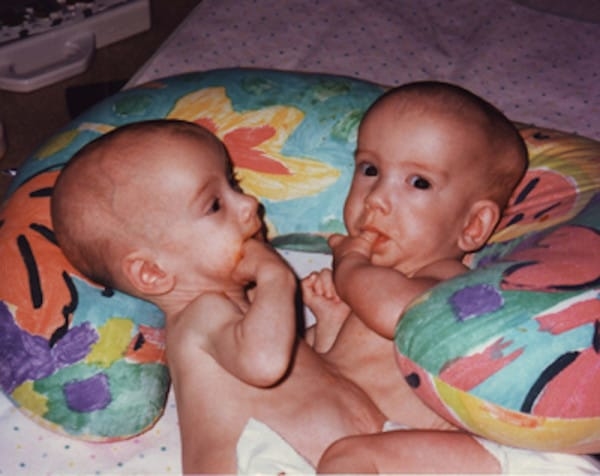 Одна жизнь на двоих: История милых сиамских близнецов