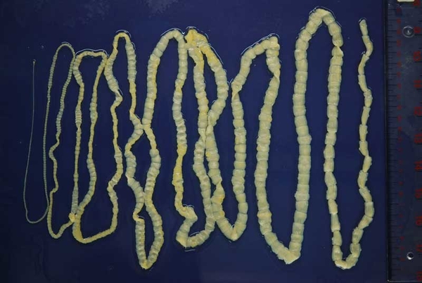 Внутри китайца обнаружили шестиметрового червя