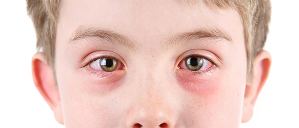 Покраснение глаз — может быть симптомом COVID-19, но нечасто