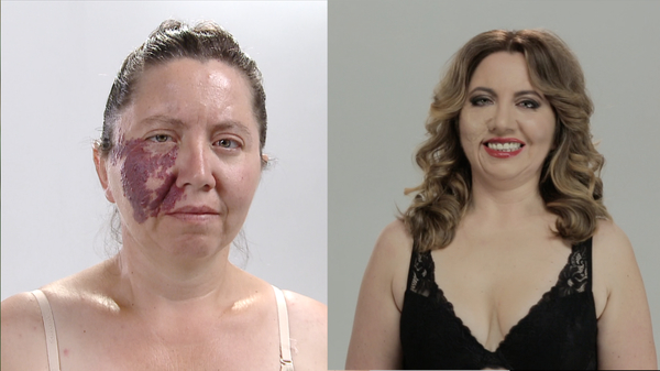 Жизнь после пластики: история женщины с "винным пятном" на лице
