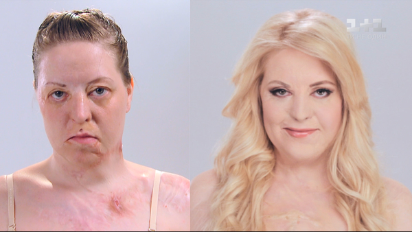 Облитая кислотой: женщине спасли жизнь и вернули красоту