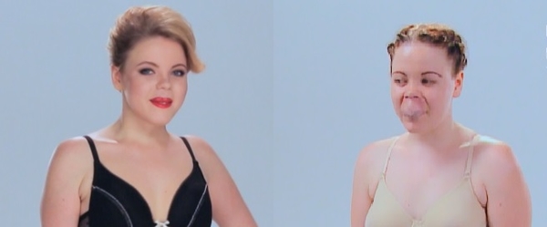 Поверніть мені красу: пациентки до и после удаления опухолей