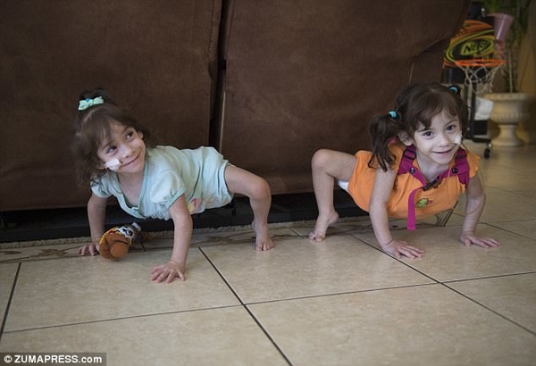 Врачи успешно разделили уникальных сиамских близнецов