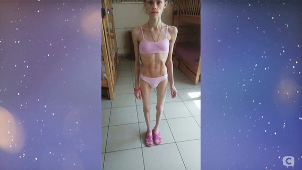 Участница "Цієї миті рік потому" бросила вызов анорексии: фото