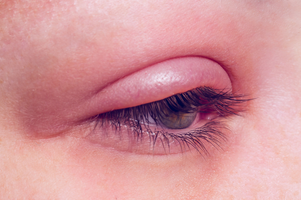 Как лечить ячмень? ✅5 способов лечения ячменя на глазу в домашних условиях