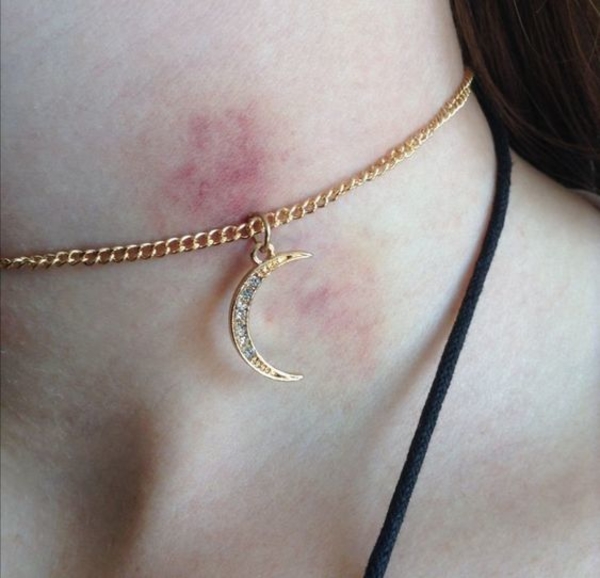 ТОП-6 эффективных способов избавиться от засоса как можно быстрее