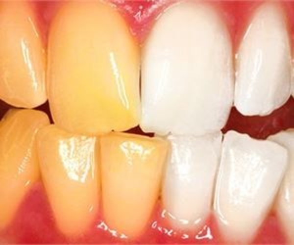 "Цвет настроения желтый": 6 причин, почему желтеют ваши зубы