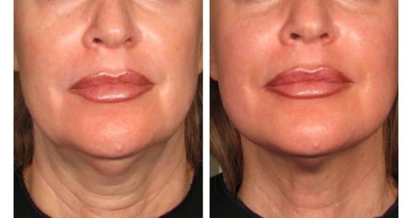 Самые эффективные уколы красоты - ТОП-5 способов удержать молодость