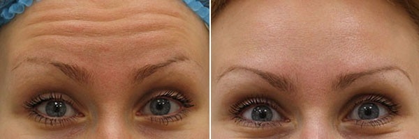 Самые эффективные уколы красоты - ТОП-5 способов удержать молодость