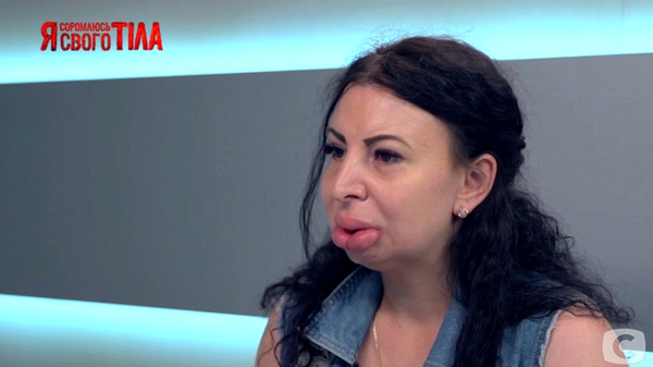 “Я соромлюсь свого тіла”: героиню с редким синдромом называют “жертвой пластики”