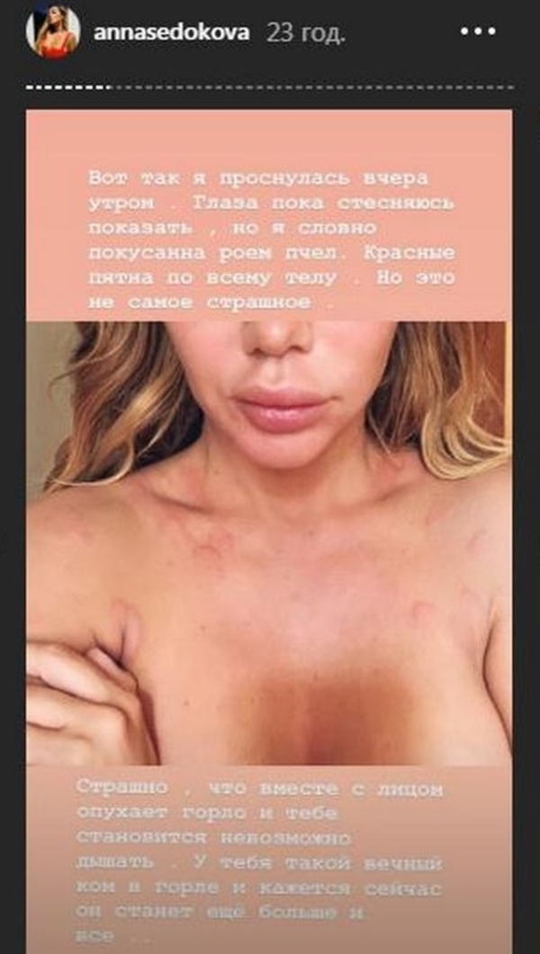 "Глаза показать боюсь": Седокова попала на реабилитацию - шокирующие кадры