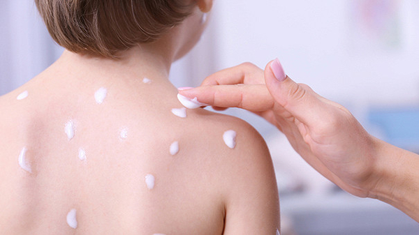 Атопический дерматит: что следует знать