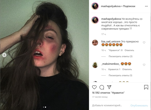 "Жертва нападения?": Дочка Поляковой поразила синяками и ссадинами