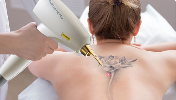 Удаление татуировки: дерматолог ответила на главные вопросы