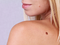 Осторожно, родинки: как выявить меланому (фото)