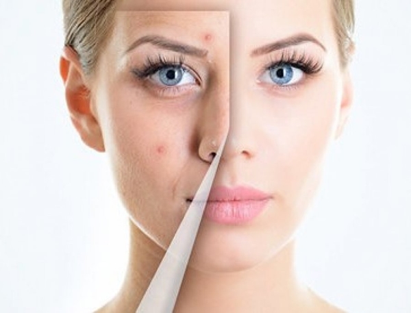 ТОП-5 главных ошибок в уходе за кожей с акне