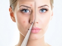 ТОП-5 главных ошибок в уходе за кожей с акне