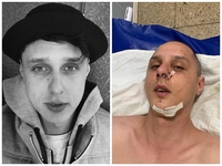 Автора хитов KAZKA сильно избили: подробности драки и фото последствий